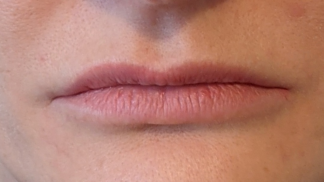 lips before treatment