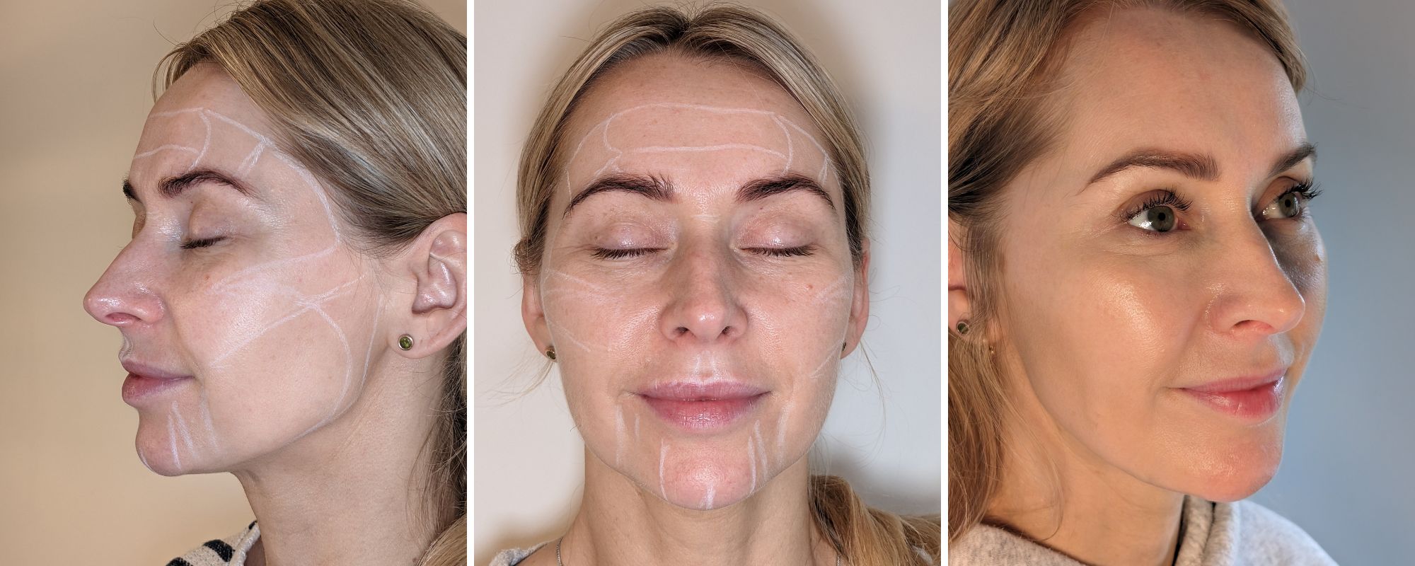 image presenting some atri-wrinkle treatments and face areas