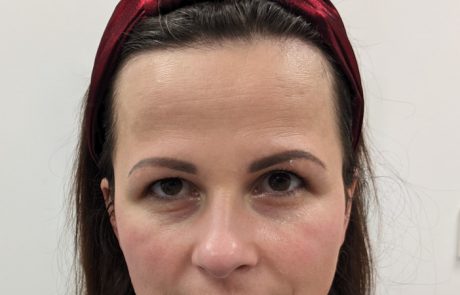 anti wrinkles treatment
