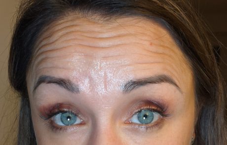 anti wrinkles treatment