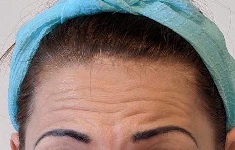anti wrinkles treatment