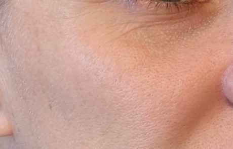 Dermal fillers add volume and reduce wrinkles