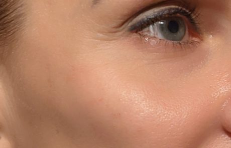 Dermal fillers add volume and reduce wrinkles