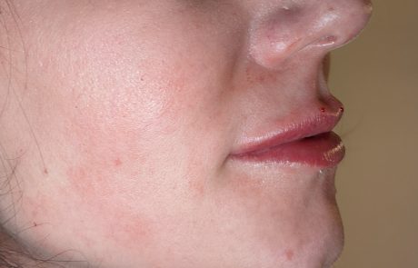 lips filler example