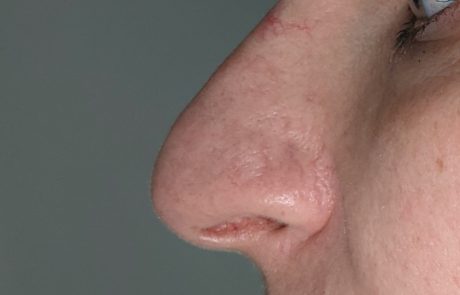 nose filler example
