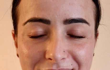 face rejuvenation example