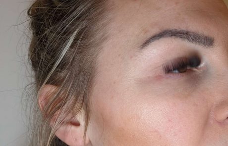 wrinkles filler example