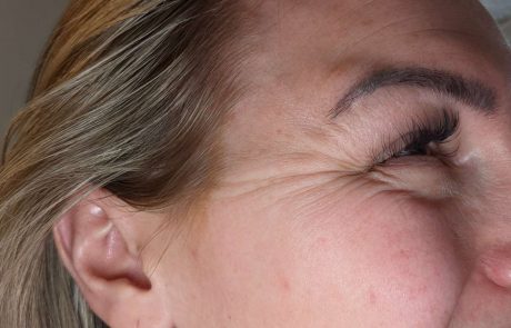 wrinkles filler example