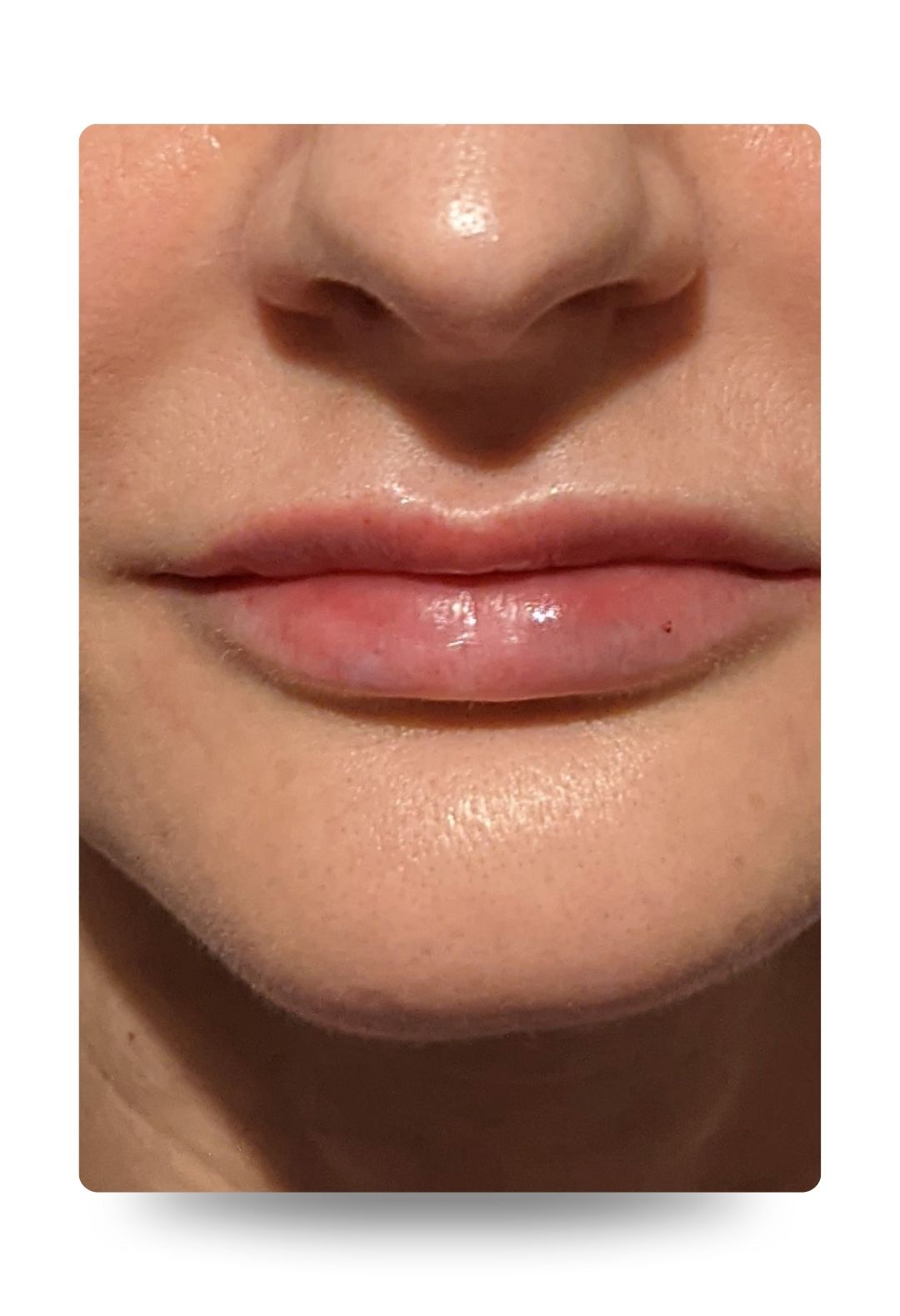 Lip Enhancement