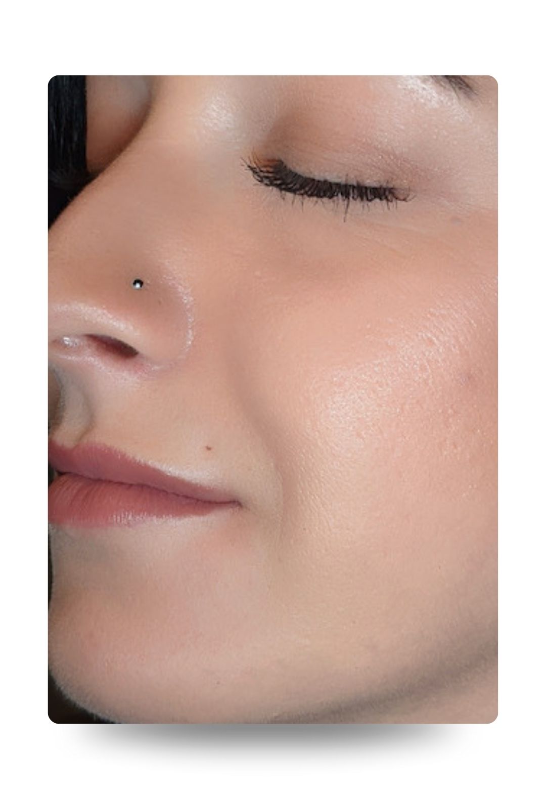 mouth lines - dermal fillers - after