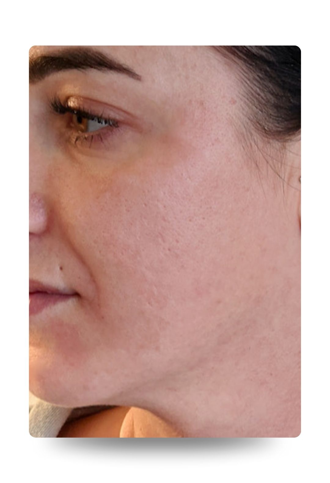 mouth lines - dermal fillers - before