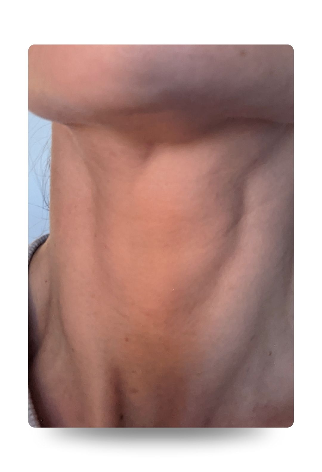 Chin Enhancement