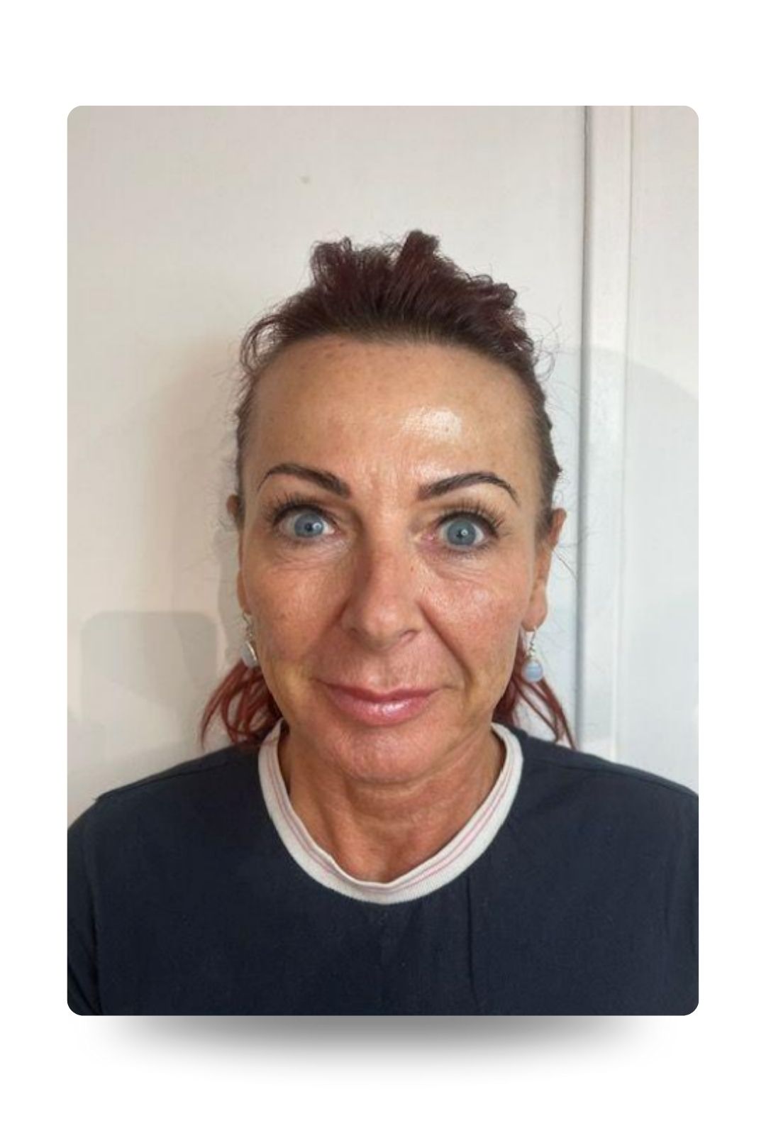 polynucleotides eye treatment – before polynucleotides eye treatment - before