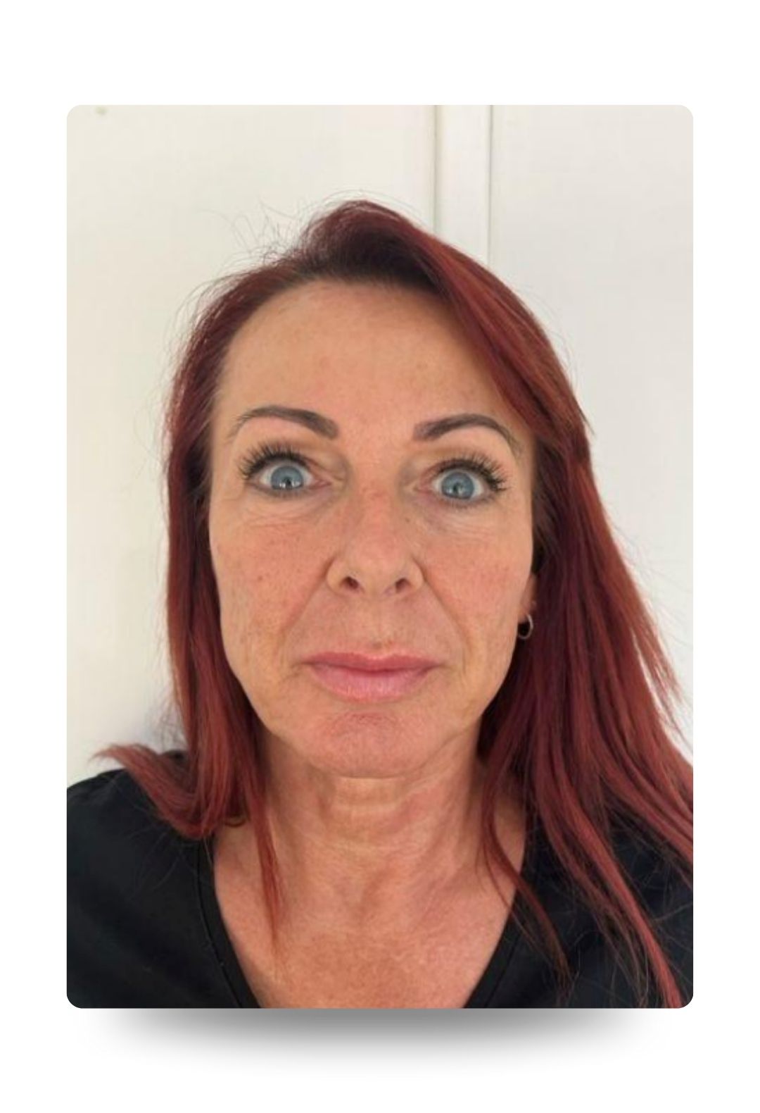polynucleotides eye treatment – after polynucleotides eye treatment - after