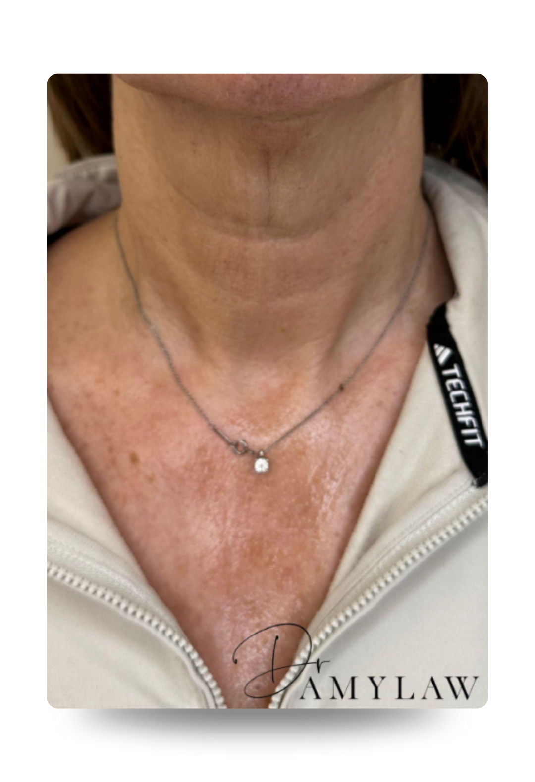 polynucleotides - Plinest newest treatment before