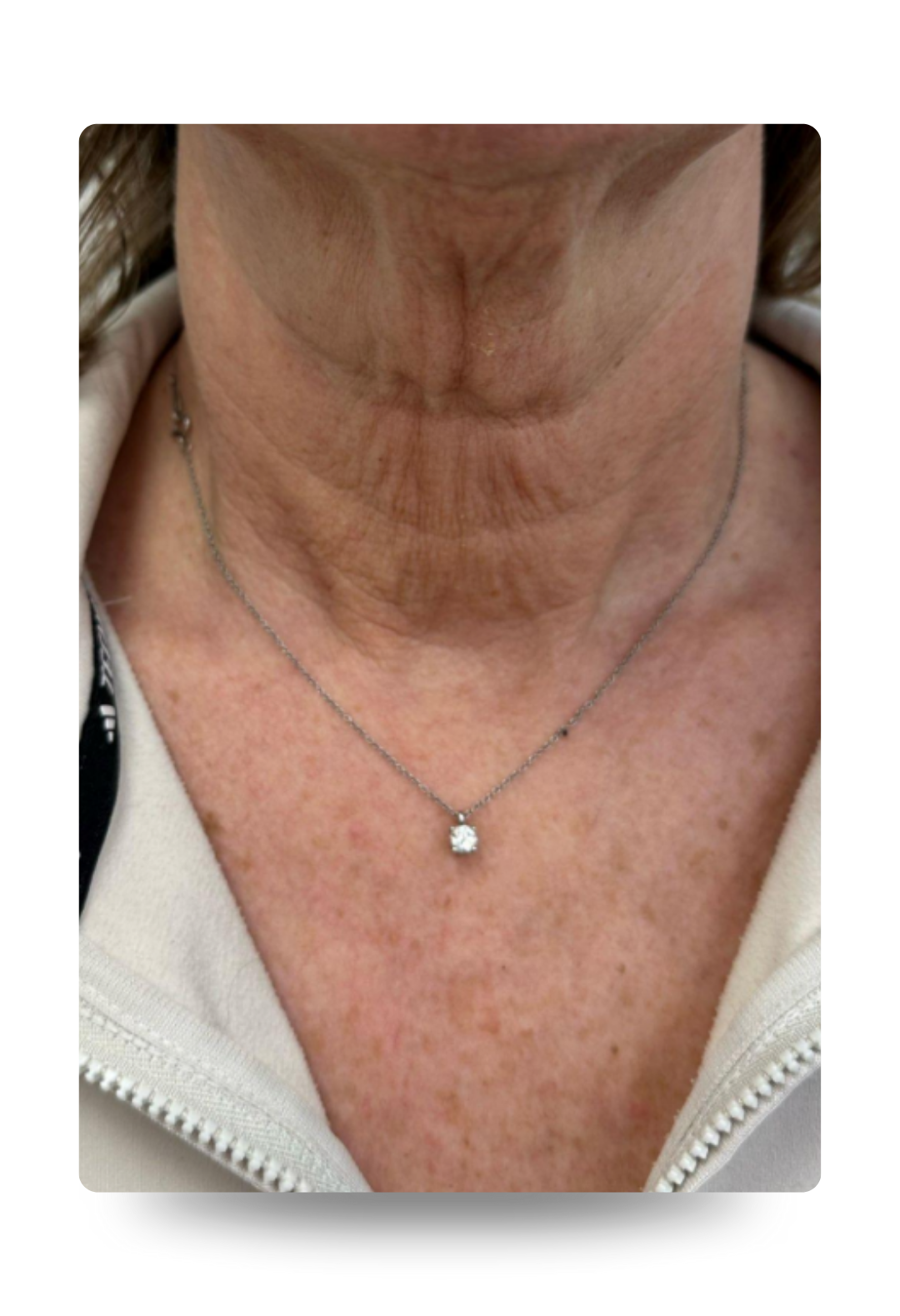 polynucleotides - Plinest newest treatment after