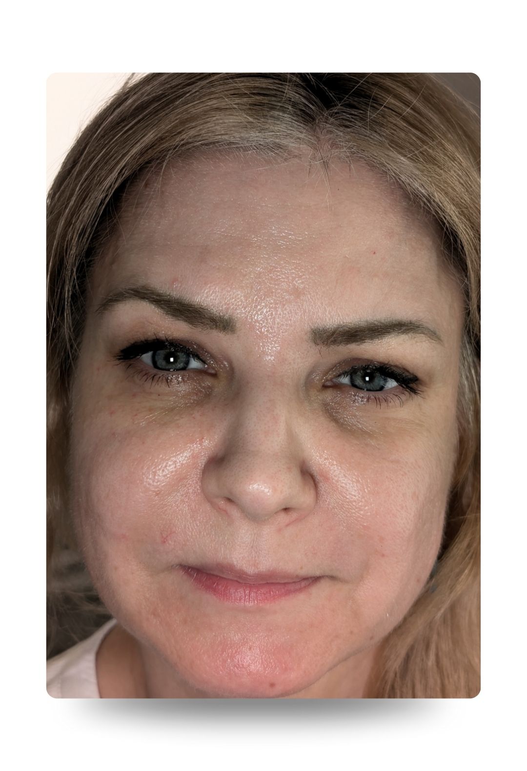 profhilo structura treatment - before