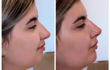 non surgical rhinoplasty and chin enhancement