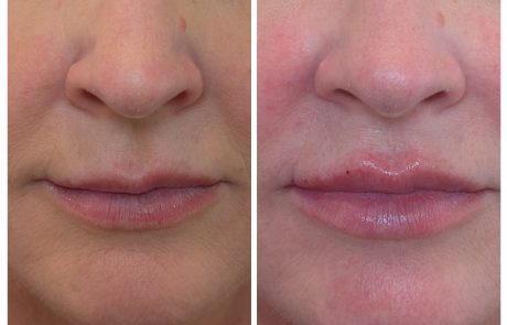 treating lips with symmetry with dermal filler