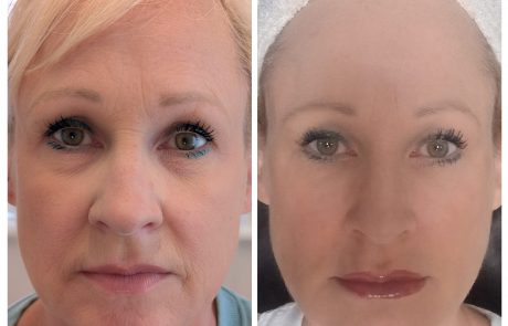 full face rejuvenation and beautification before after