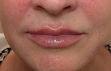treating lips with symmetry with dermal filler after