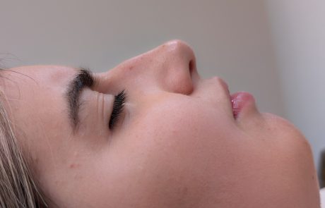 non surgical rhinoplasty and chin enhancement before