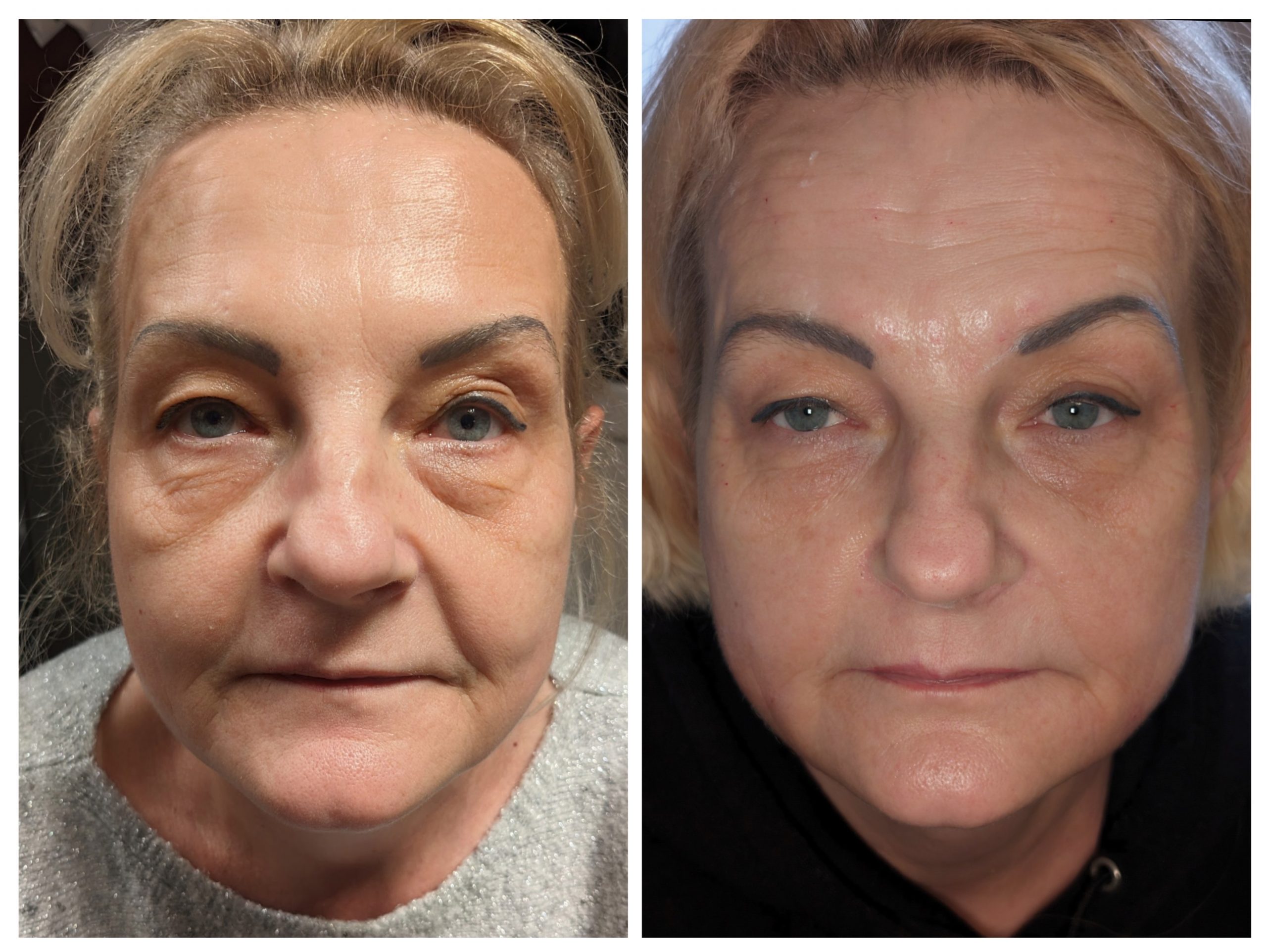 non surgical rhinoplasty