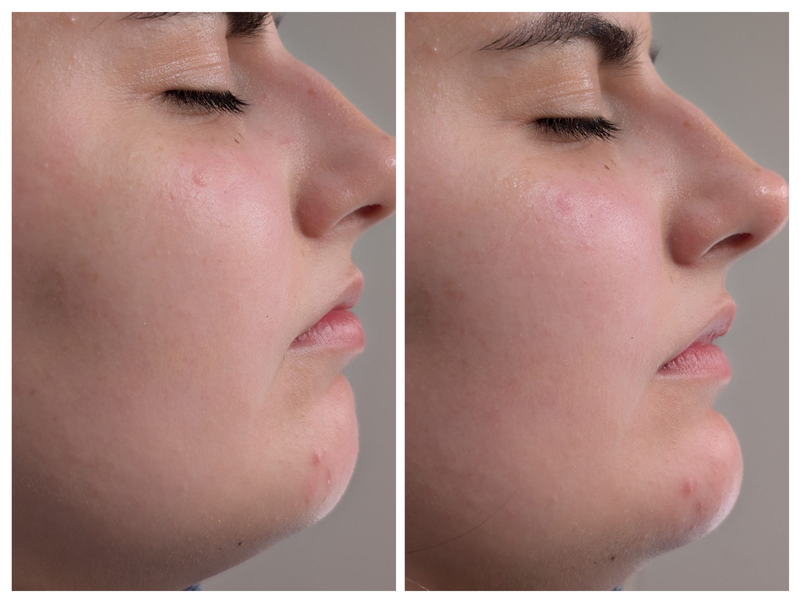 chin structural rejuvenation
