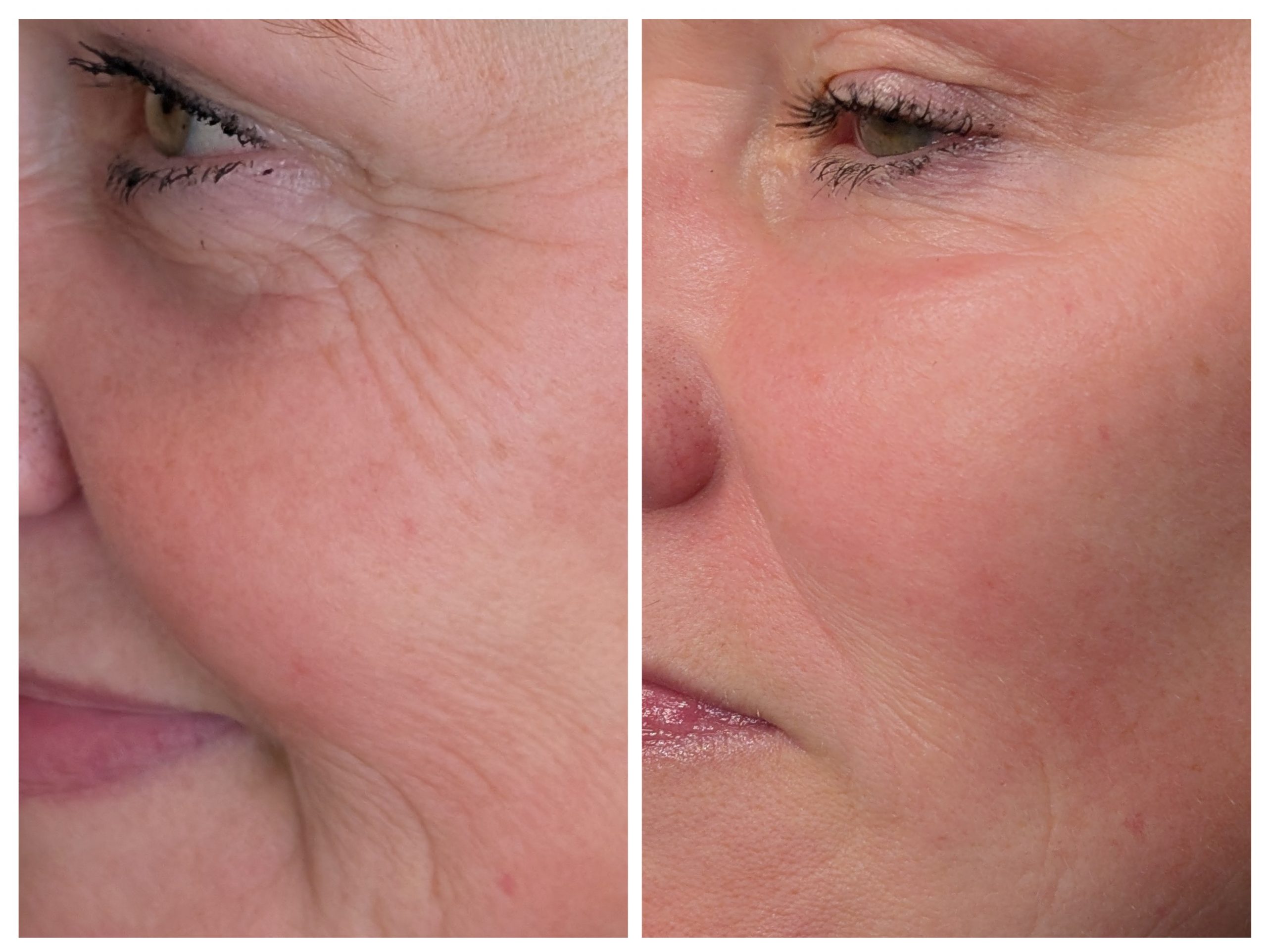non surgical rhinoplasty