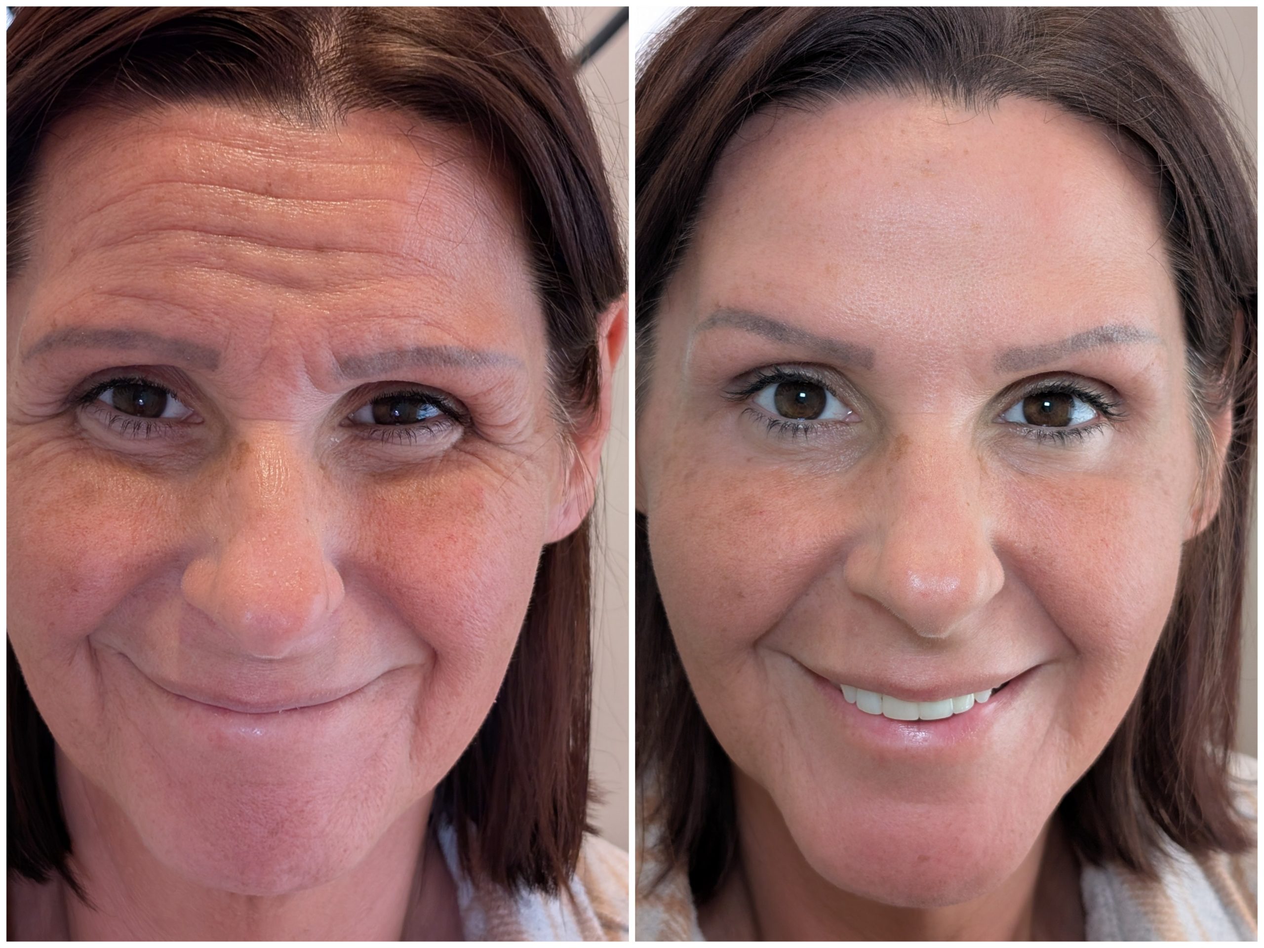 non surgical rhinoplasty