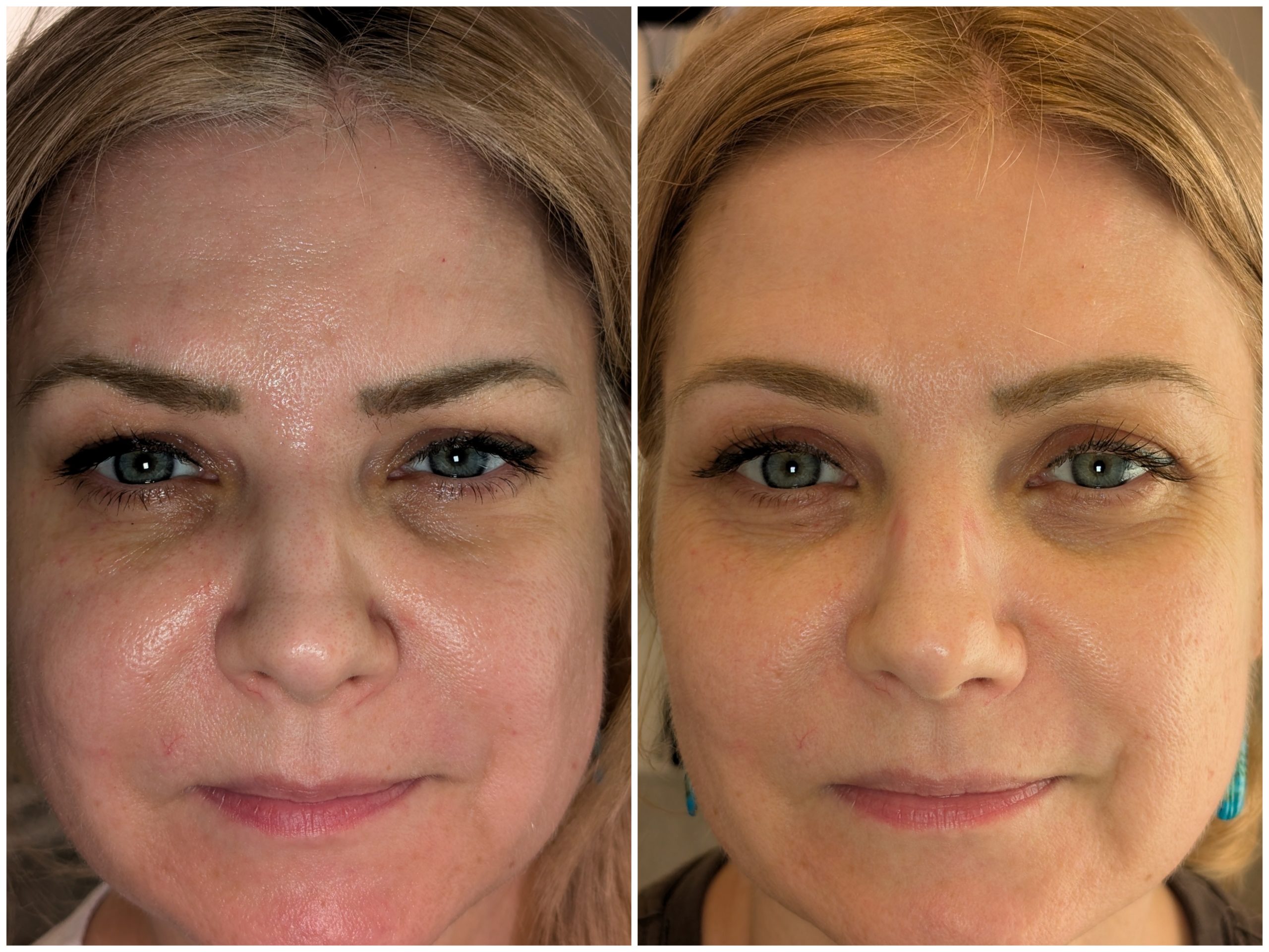non surgical rhinoplasty