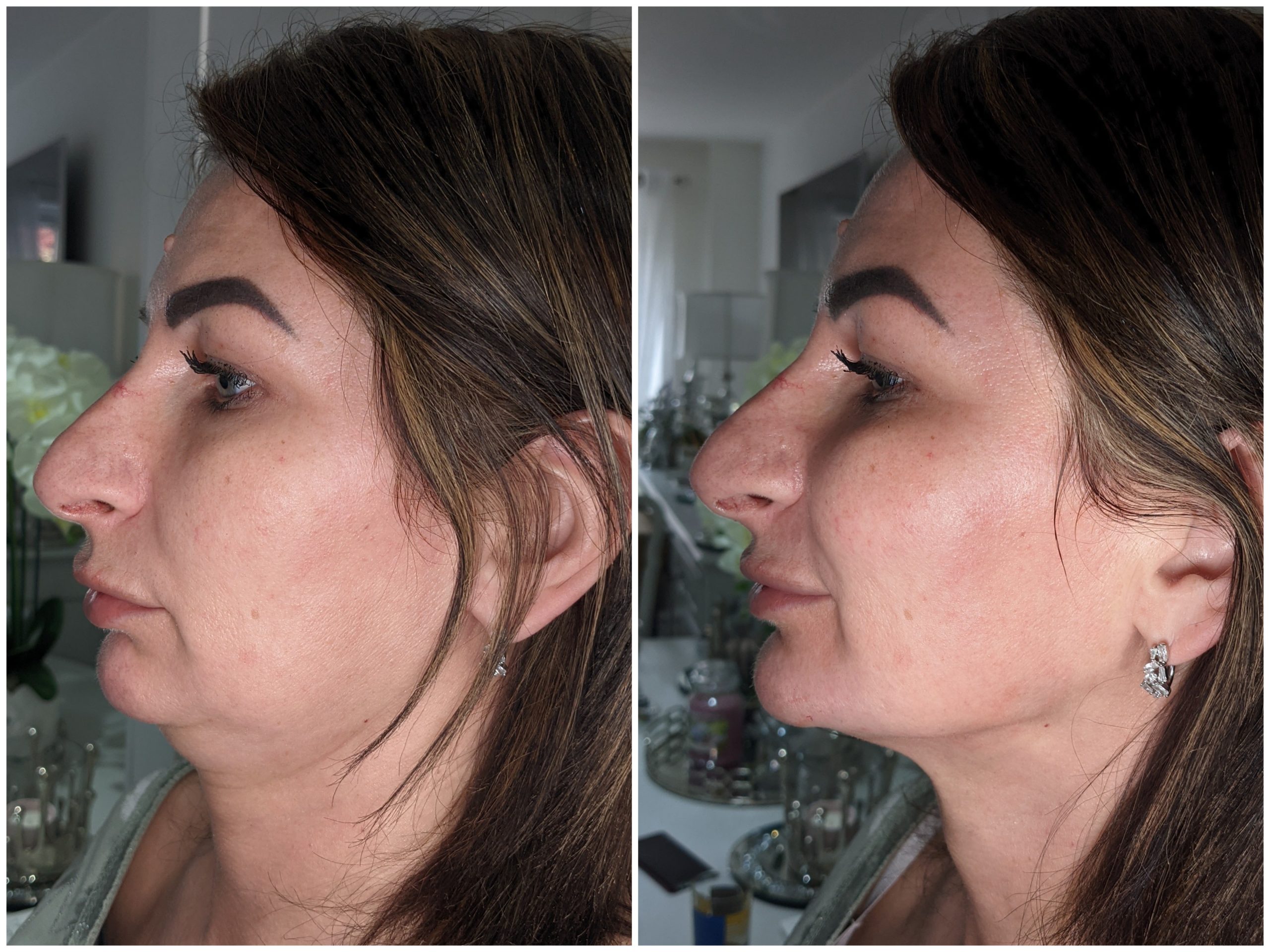 non surgical rhinoplasty