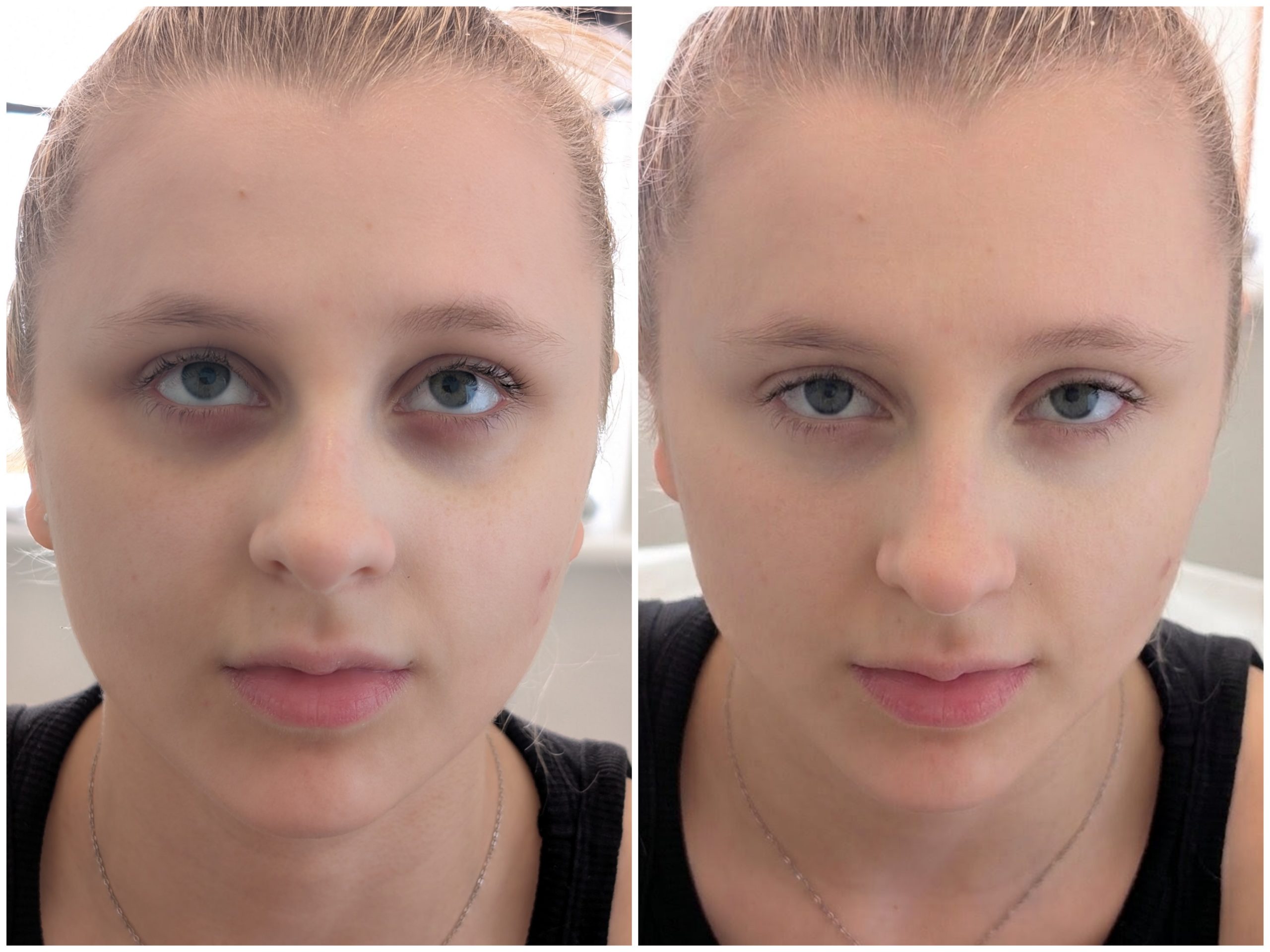 non surgical rhinoplasty